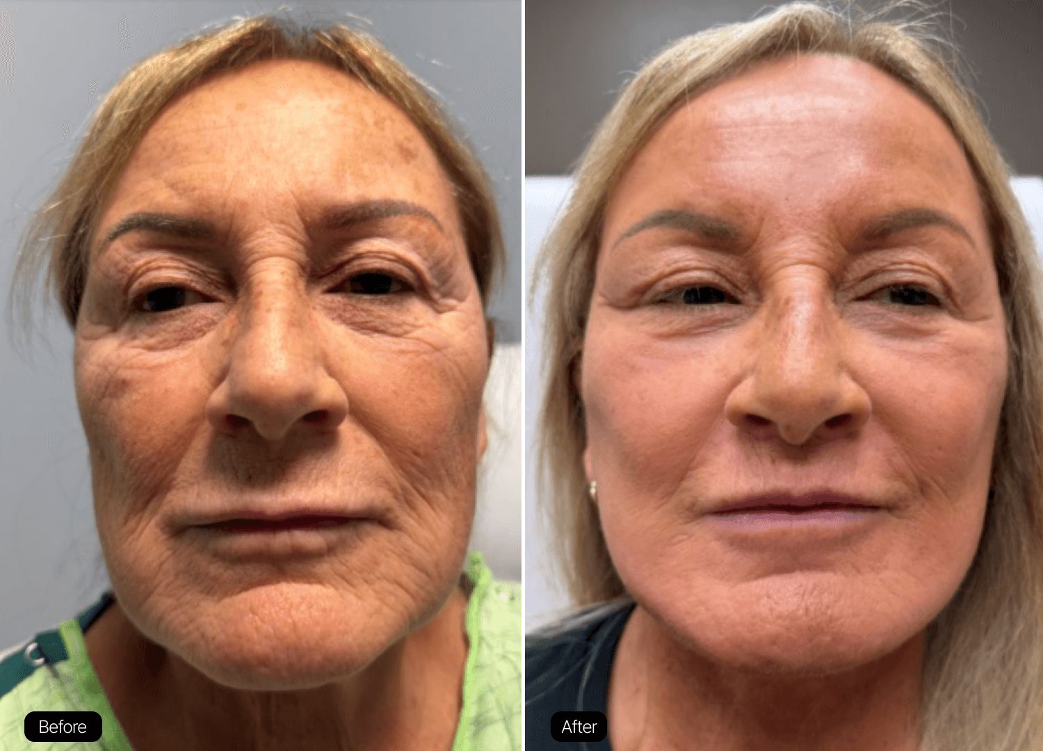 08 - Facelift