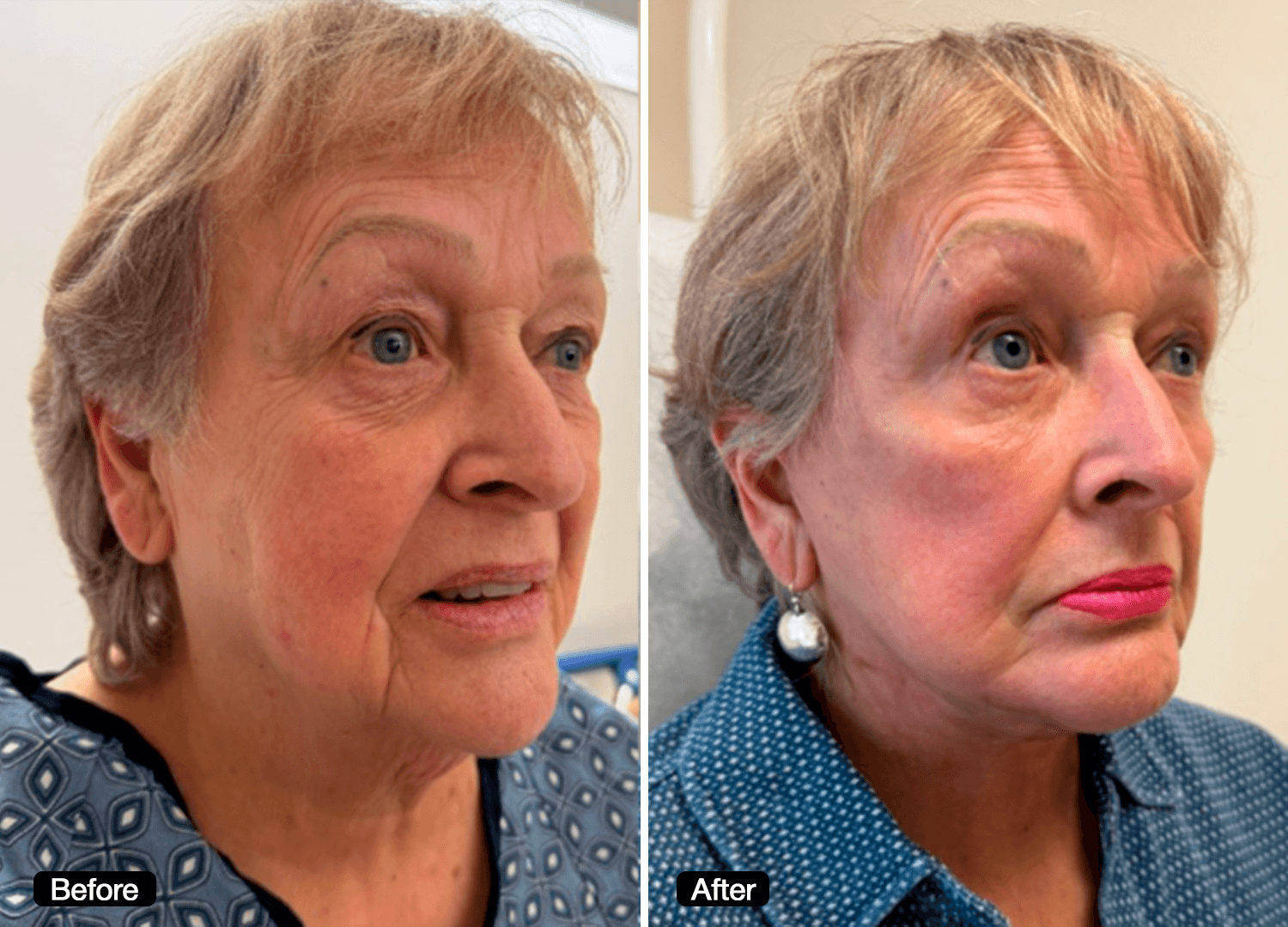 1 - Facelift