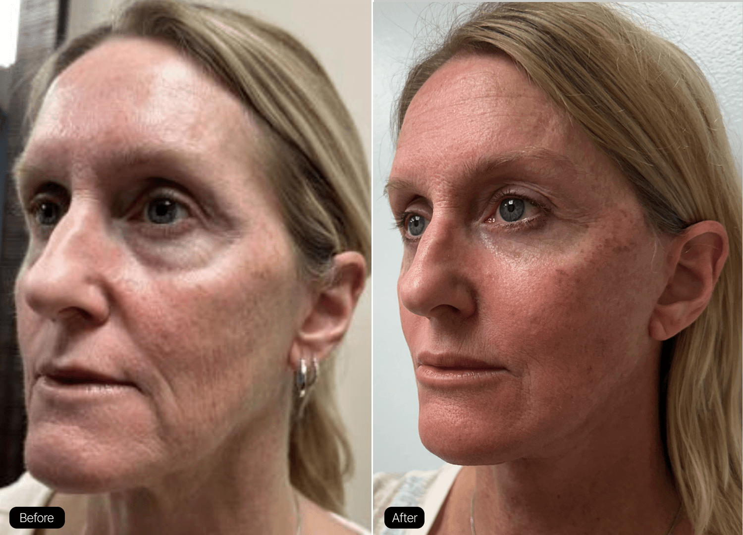 11 - Facelift