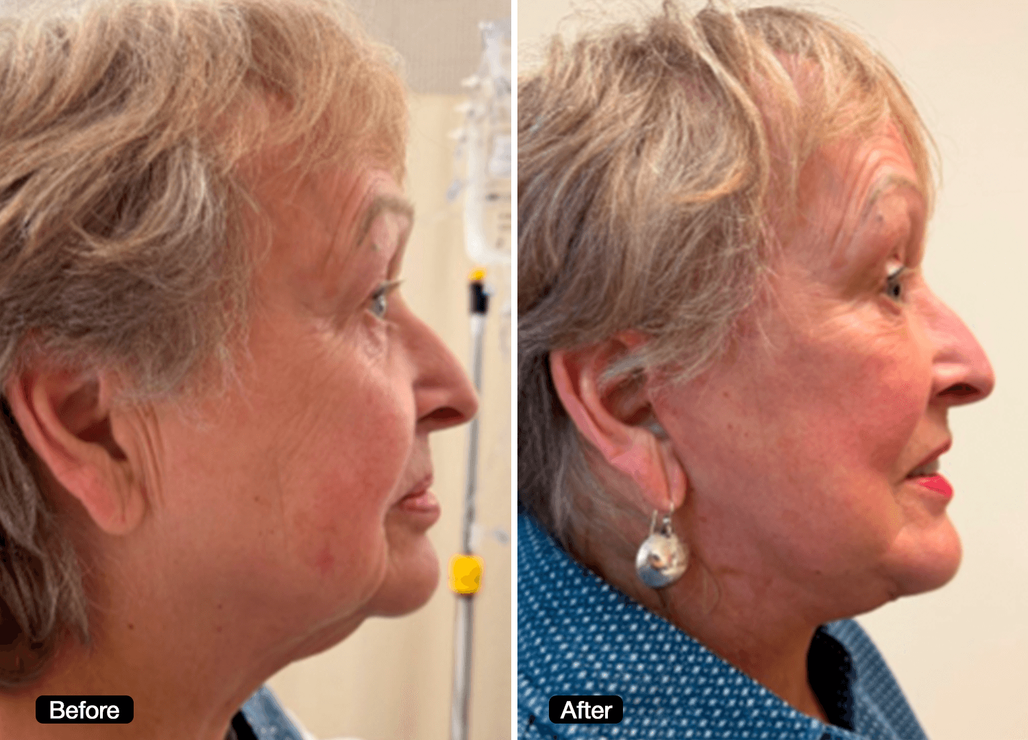 2 - Facelift