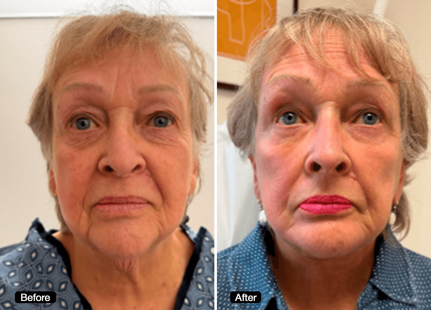 3 - Facelift