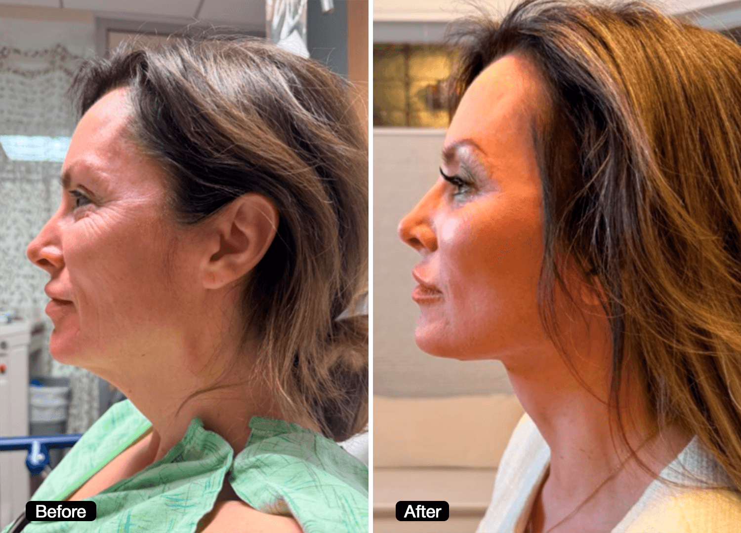 6 - Facelift